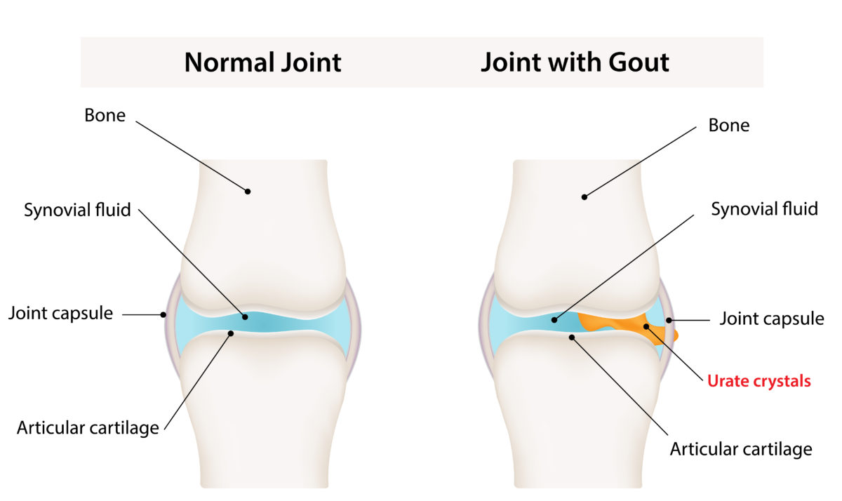 Synovial,Joint,With,Gout